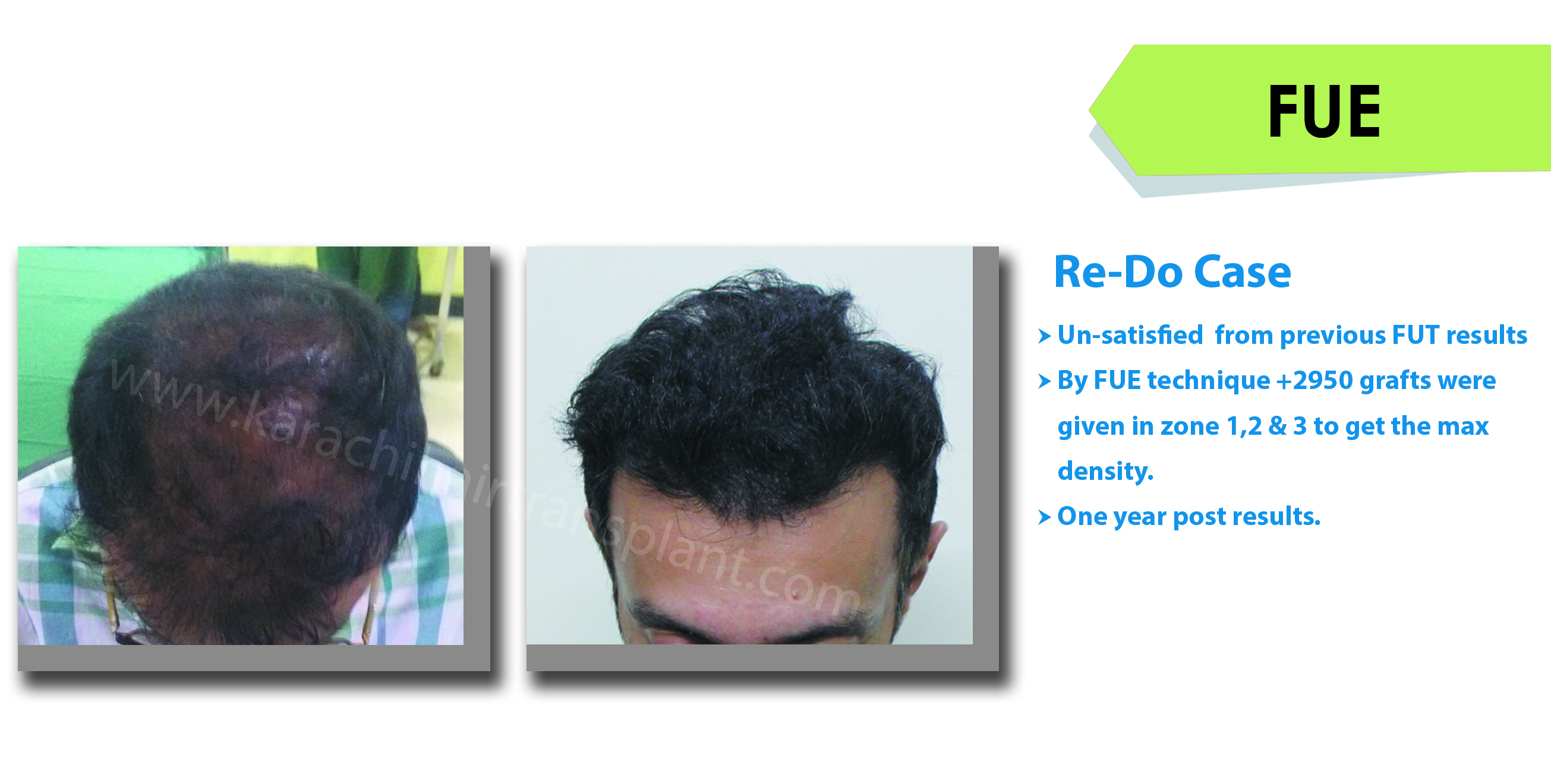 Karachi Hair Transplant Results